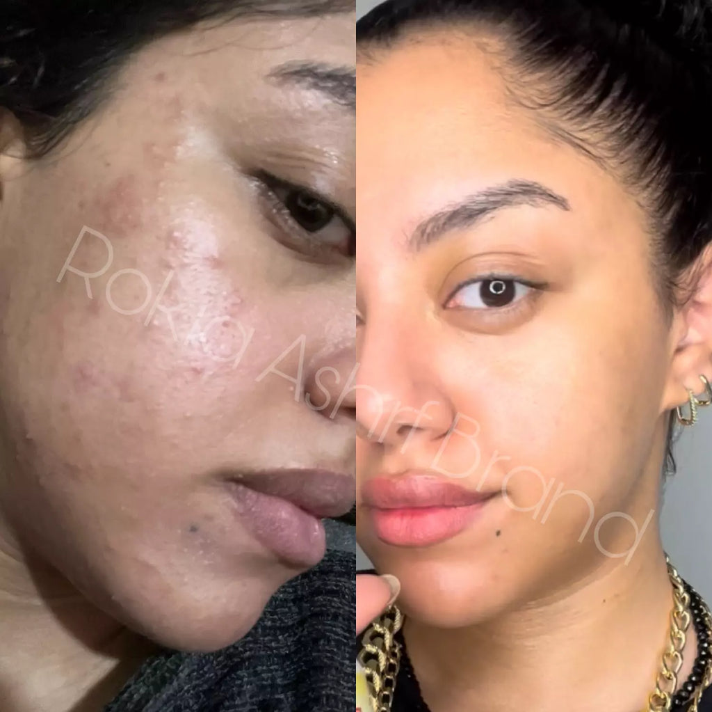 صابونة سوبر ترينينج اكني طبيه للتنضيف العميق وعلاج الحبوب للبشره الدهنيه والمختلطه ومناسبة للجسم بالسالسيليك اسيد و الاكنيسيدول وشجرة الشاي والجلسرين