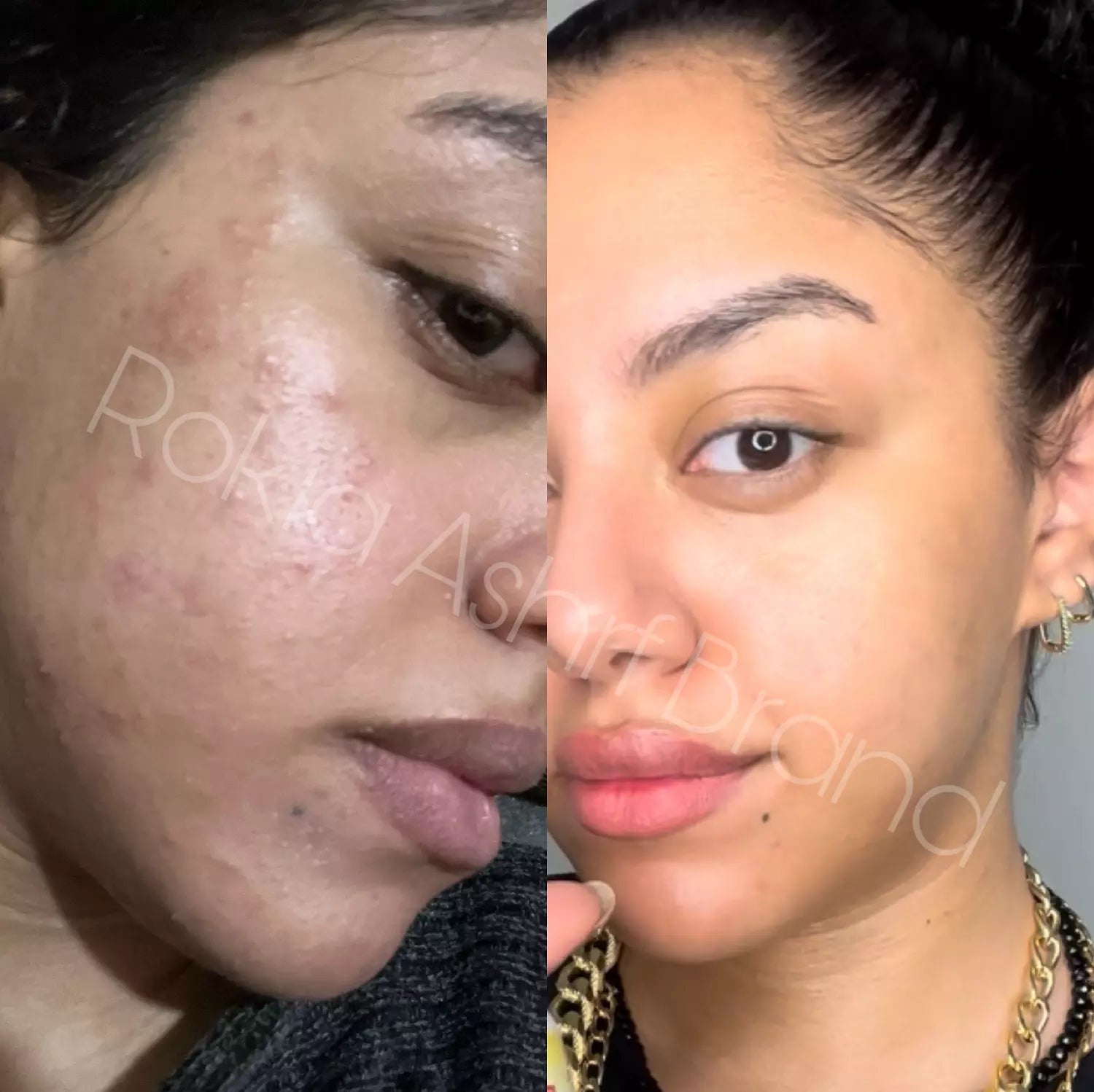 صابونة سوبر ترينينج اكني طبيه للتنضيف العميق وعلاج الحبوب للبشره الدهنيه والمختلطه ومناسبة للجسم بالسالسيليك اسيد و الاكنيسيدول وشجرة الشاي والجلسرين