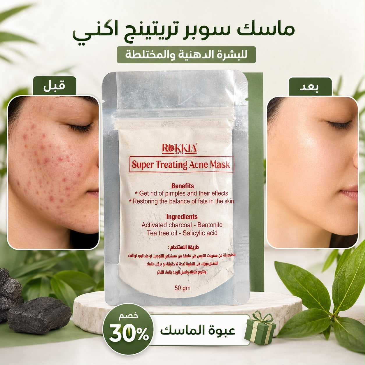 ماسك سوبر تريتينج اكني للبشره الدهنيه والمختلطه -  ماسك سوبر تريتينج اكني - مناسب لكل مناطق الجسم لعلاج الحبوب - بالطمي الطبي المعالج و الفحم النشط و السالسيلك اسيد و شجرة الشاي و البنتونيت