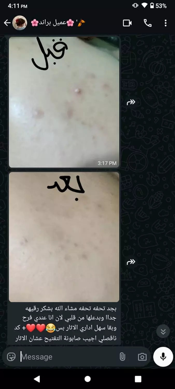 صابونة سوبر ترينينج اكني طبيه للتنضيف العميق وعلاج الحبوب للبشره الدهنيه والمختلطه ومناسبة للجسم بالسالسيليك اسيد و الاكنيسيدول وشجرة الشاي والجلسرين