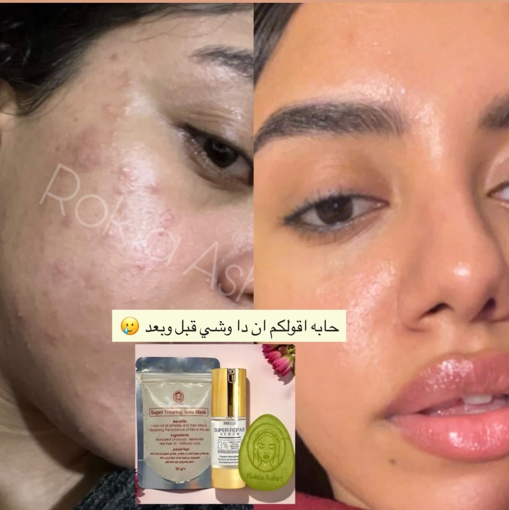 بوكس البشره الدهنيه والمخطلته لعلاج الحبوب والحد من الافرازات الدهنيه ونضارة البشرة | صابونة سوبر تريتينج اكني - ماسك سوبر تريتينج - سيروم الهايلورونيك والنياسيناميد