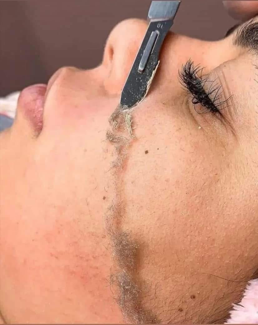الديرما بلانينج Dermaplaning
اداة الديرما + 20 مشرط هدية