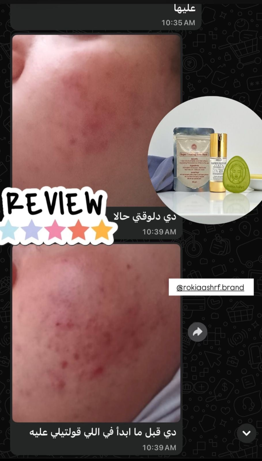 صابونة سوبر ترينينج اكني طبيه للتنضيف العميق وعلاج الحبوب للبشره الدهنيه والمختلطه ومناسبة للجسم بالسالسيليك اسيد و الاكنيسيدول وشجرة الشاي والجلسرين
