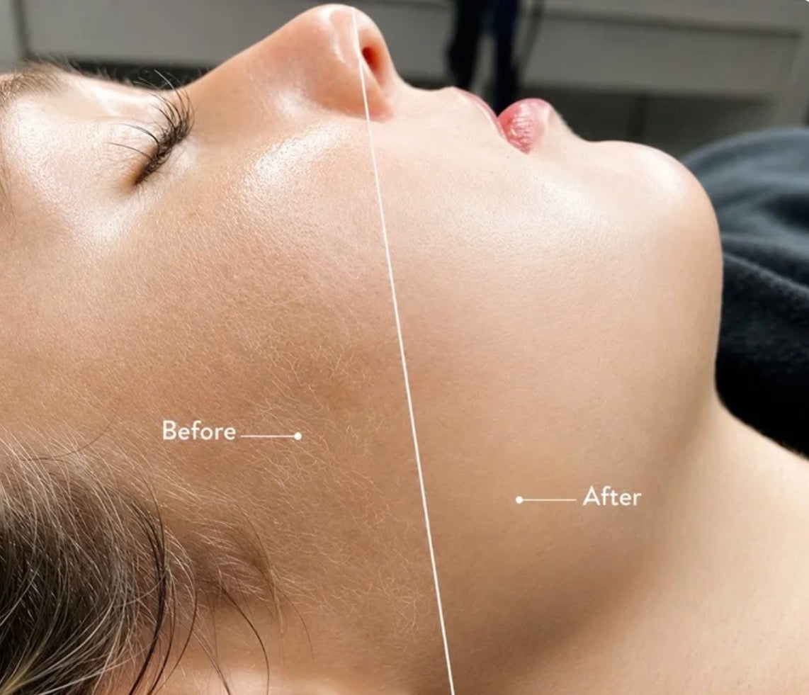 الديرما بلانينج Dermaplaning
اداة الديرما + 20 مشرط هدية